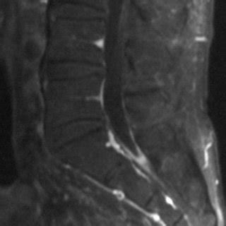 Sagittal Section Of Gadolinium Enhanced T1 Weighted MRI Revealed A