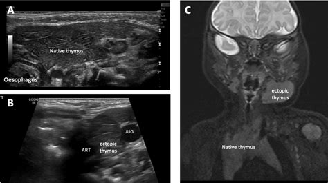 Ectopic Cervical Thymus Not Your Average Neck Lump Archives Of