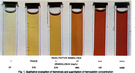 Figure From Effect Of In Vitro Hemolysis On Chemical Values For Serum