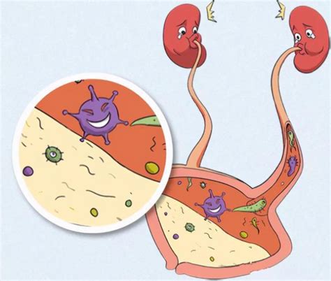 引起反复发作尿路感染的原因有哪些？ 间质之家