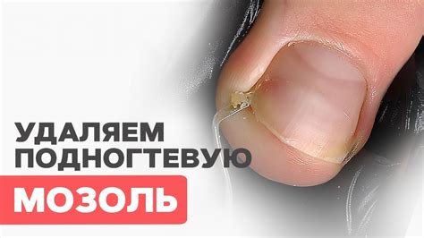 ПОДНОГТЕВАЯ мозоль | Как удалить? - YouTube