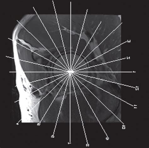 Demystifying Radial Imaging Of The Hip Radiographics