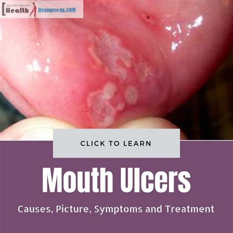 mouth ulcers   mouth ulcers    treat