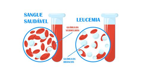Glóbulos Vermelhos Altos Sintomas - Glóbulos Vermelhos Baixos | Anemia: Sintomas, Tipos, o que é ...