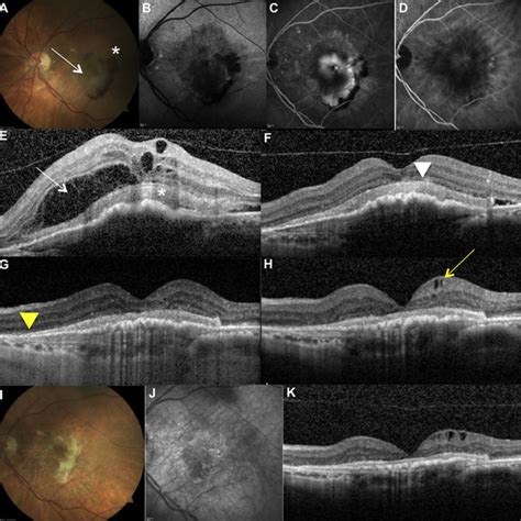 Multimodal Imaging Of Neovascular Age Related Macular Degeneration