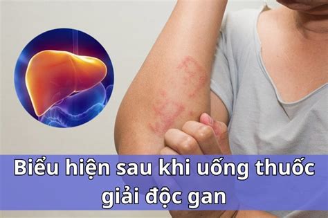 Hickey Là Gì Cách Tạo Dấu Hickey đẹp ấn Tượng An Toàn Nhất Hebemartvn