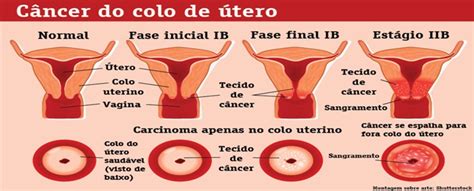 Rio De Sa De C Ncer Do Colo Do Tero Como Reconhecer Os Sinais E Sintomas