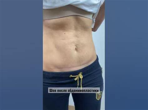 Шов после мини-абдоминопластики | 4 месяца после операции # ...