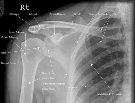 Anatomically labelled AP shoulder x-ray. | Medical anatomy, Radiology