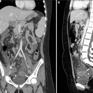 A Abdominal Contrast Enhanced CT Portal Venous Phase Coronal Image