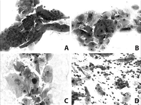 Figure 1 From Anal Cytology In An HIV Positive Population Semantic Scholar
