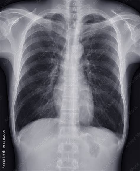 Chest x-ray image for screening diagnosis TB,tuberculosis and covid-19 ...