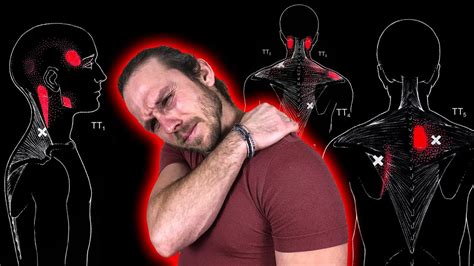 ЖГУЧАЯ БОЛЬ в СПИНЕ в области ЛОПАТОК, ПЛЕЧА, ШЕИ и ГОЛОВЫ 🔴 Триггерные ...