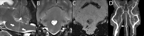 Sequence Specific Mr Imaging Findings That Are Useful In Dating Ischemic Stroke 1 Telegraph