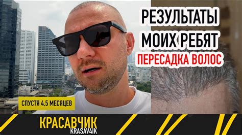 ТОП Наблюдений и рекомендаций спустя 9 месяцев после пересадки волос ...