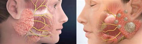 Parotid Gland Mass