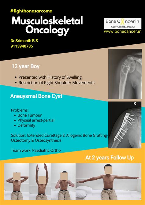 Aneurysmal Bone Cyst - BoneCancer.in Aneurysmal Bone Cyst: Treatment