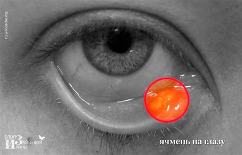 Ячмень на глазу. Причины появления и лечение