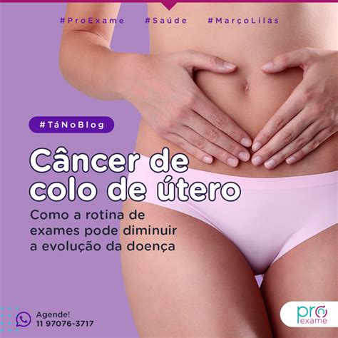 Aprender Sobre Imagem Cancer De Colo De Utero Fotos Br