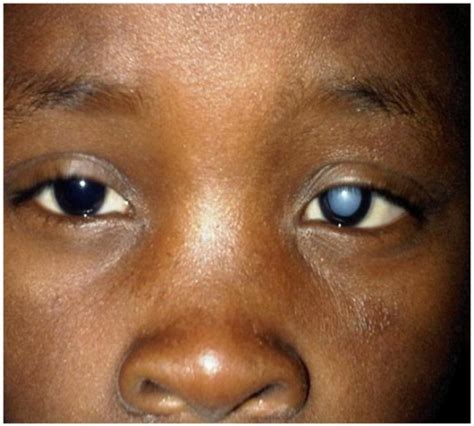 Cataracts In Children Concise Medical Knowledge