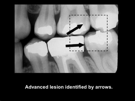 Radiographic Caries Diagnosis