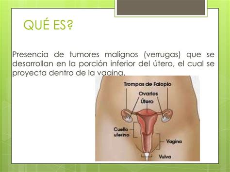 Sesion Educativa Cancer De Cuello Uterino Citolog A Prevenci N