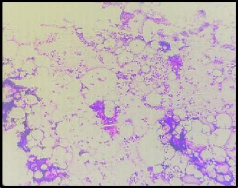 Bone Marrow Aspirate Smear In Aplastic Anaemia Show Reduced Cellularity Download Scientific