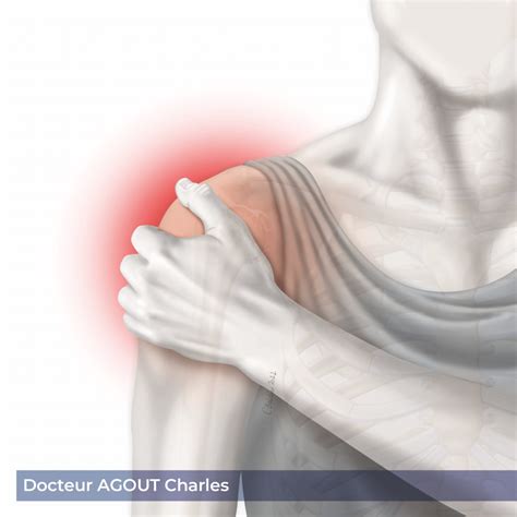 Arthrose acromioclaviculaire à Bordeaux Chirurgien de l épaule Dr Agout