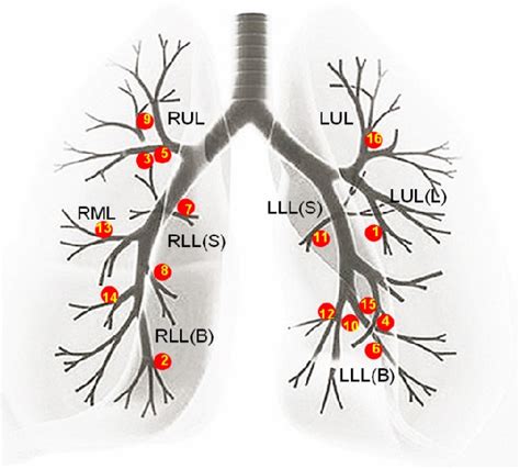 Figure From Radial Probe Endobronchial Ultrasound Assisted