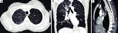 Contrast Enhanced Multidetector Computed Tomography Mdct Mm