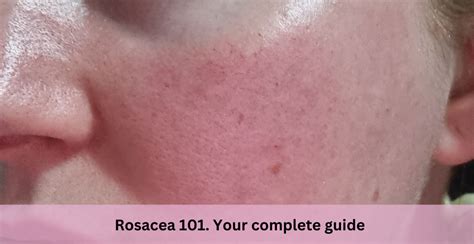 Rosacea Your Complete Guide The Naked Chemist