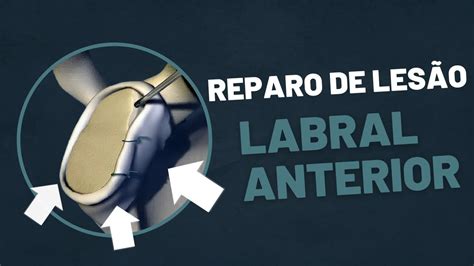 Artroscopia Reparo de Lesão Labral Anterior Dr Gustavo Barboza