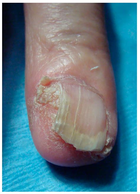 diagnosis  management  malignant epithelial nail unit tumors