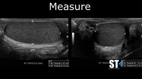 Testicular Scrotal Doppler Protocol Sonographic Tendencies