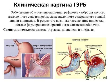 Лечение гэрб: самые эффективные препараты - схема лечения с эзофагитом