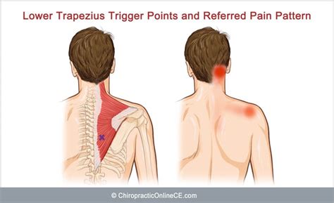 Unit 2 Atlanto Occipital Joint Dysfunction Lifewest N U2 23 Chiropractic Online Ce™ Official