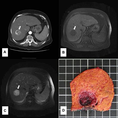 Cavernous Hemangioma Liver Ultrasound