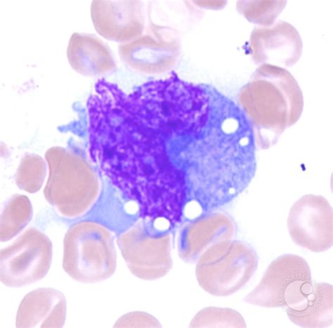 Anaplastic Large Cell Lymphoma Involving the Bone Marrow - 2.