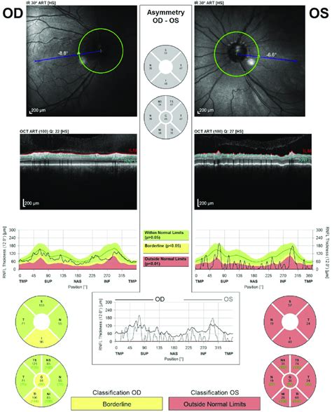 Spectral Domain Optical Coherence Tomography Sd Oct Of The Optic