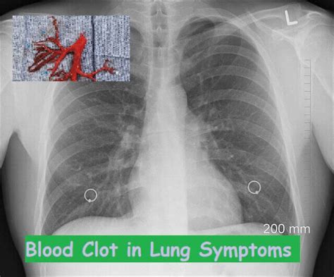 15 Blood Clot In Lung Symptoms, Causes, And Diagnosis [Pulmonary ...