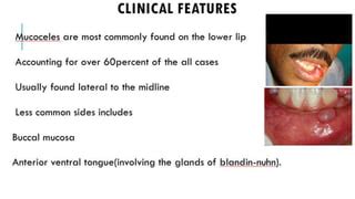 Mucocele and Renula | PPT