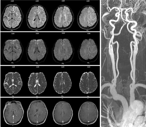 Brain MRI and MR angiography in a 66-year-old female with acute serial ...