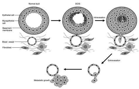 Breast Cancer Metastasis Cancer Genomics Proteomics