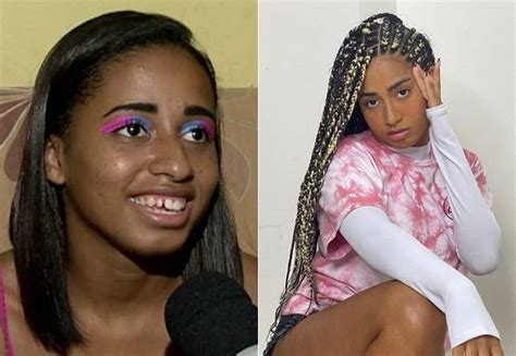 Antes e depois MC Loma mostra primeira etapa de sua harmonização facial