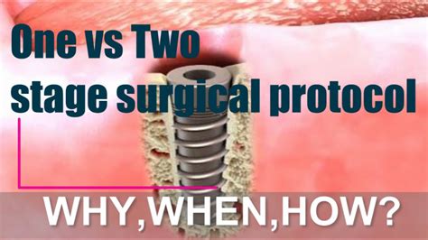 One Stage Vs Two Stage Surgical Protocol Youtube