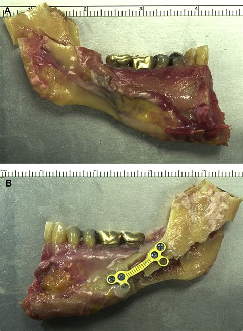 Three Dimensional Computed Tomographic Evaluation Of Bilateral Sagittal