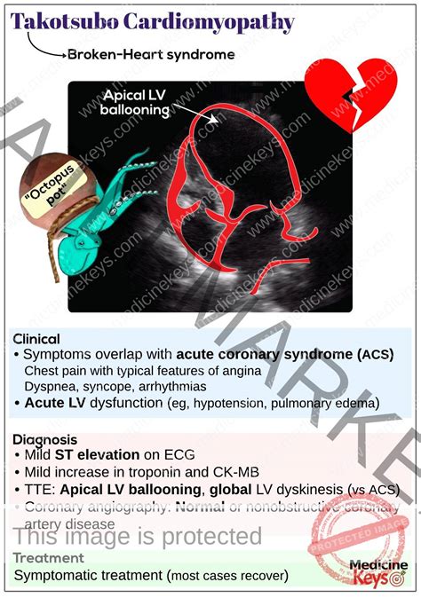 Takotsubo cardiomyopathy - Medicine Keys for MRCPs