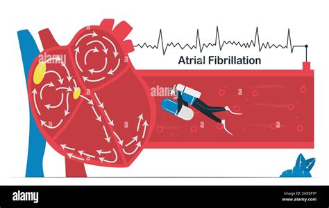 Fibrillazione Atriale Ecg Immagini E Fotografie Stock Ad Alta