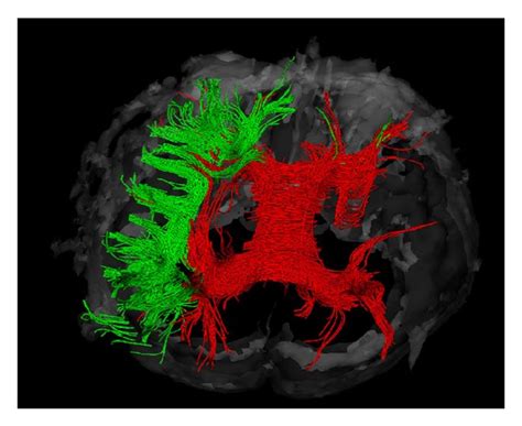 Spatial relation of the superior longitudinal fasciculus and the ...