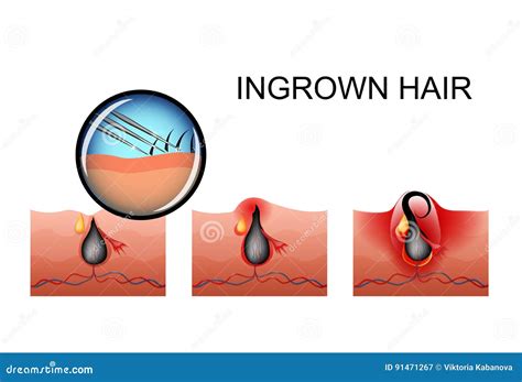 how to fix ingrown hair pimple
